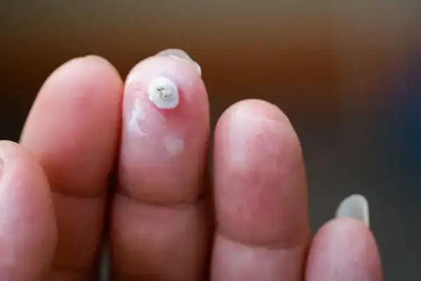 Image of white wart before cryopen treatment Clifton