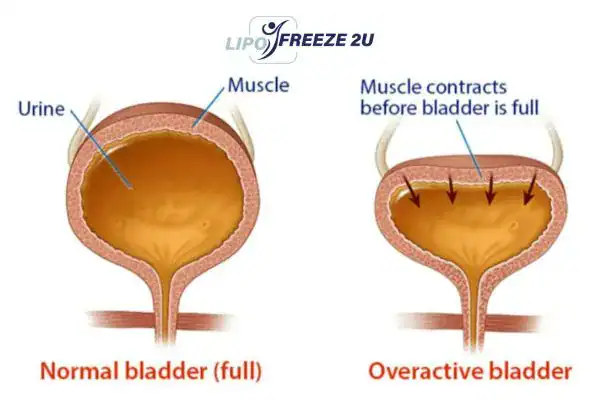 diagram of overactive bladder treatment Clifton