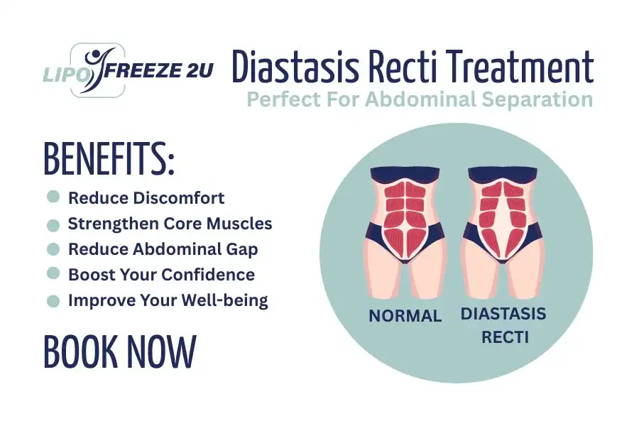 Benefits of body toning treatment Clifton for Diastasis recti