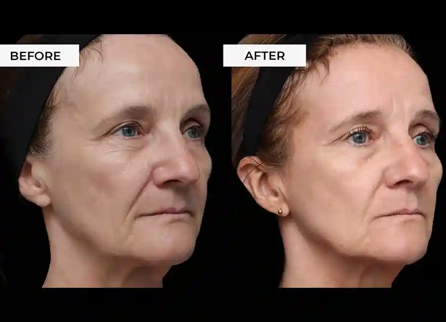 How Many RF Microneedling Sessions Will You Need to See a Difference Clifton?