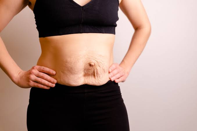 Is Surgery Really the Only Way to Repair Diastasis Recti Clifton?
