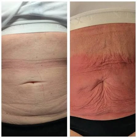 How Does RF Microneedling Improve Crepey, Thin and Uneven Skin Texture Clifton?