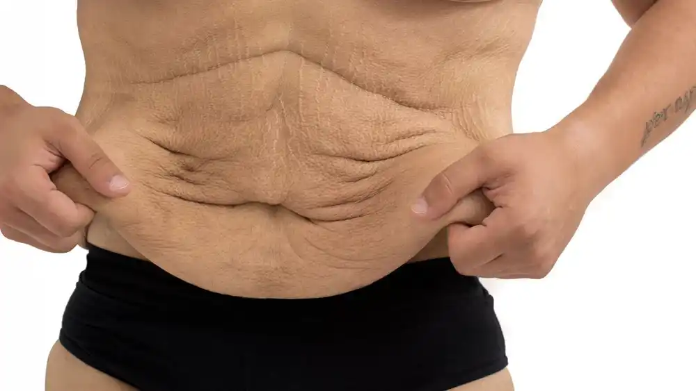 RF Microneedling for Loose Skin: How Can It Help Tighten and Reshape the Skin Clifton?